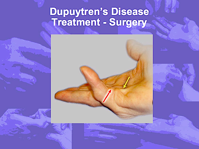 dupuytren-s-disease-hand-surgery-resource